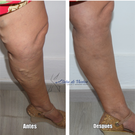 Parches para varices