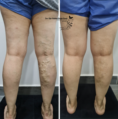 Parches para varices