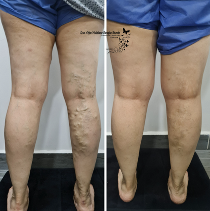 Parches para varices