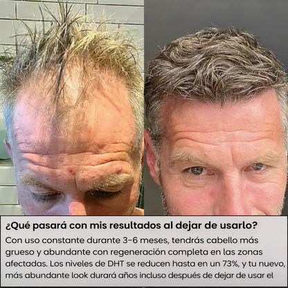 Sistema de regeneración capilar